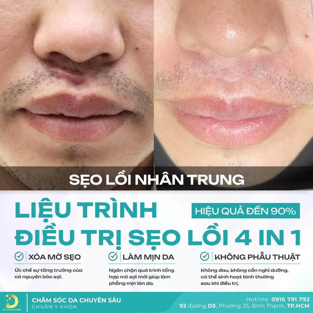 Trị Sẹo Lồi Chuyên Sâu Với Công Nghệ Độc Quyền Tại Dr. Choice Clinic 9
