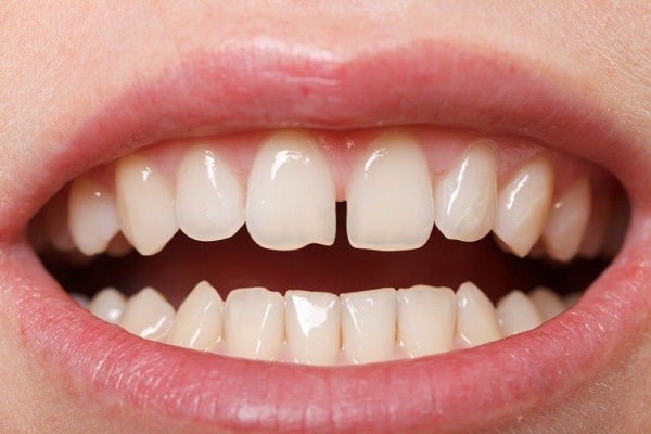 Tại sao người Anh lại có răng xấu như vậy? 8